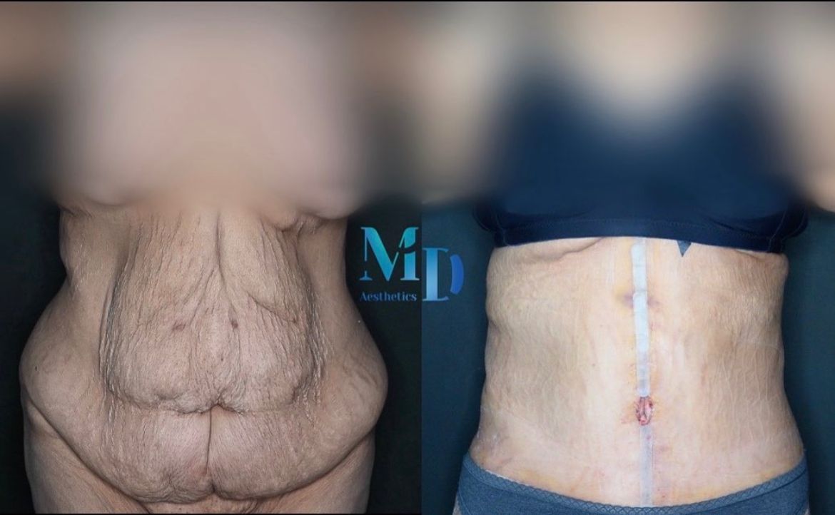 Murat Diyarbakırlıoğlu | Post Bariatric Surgery