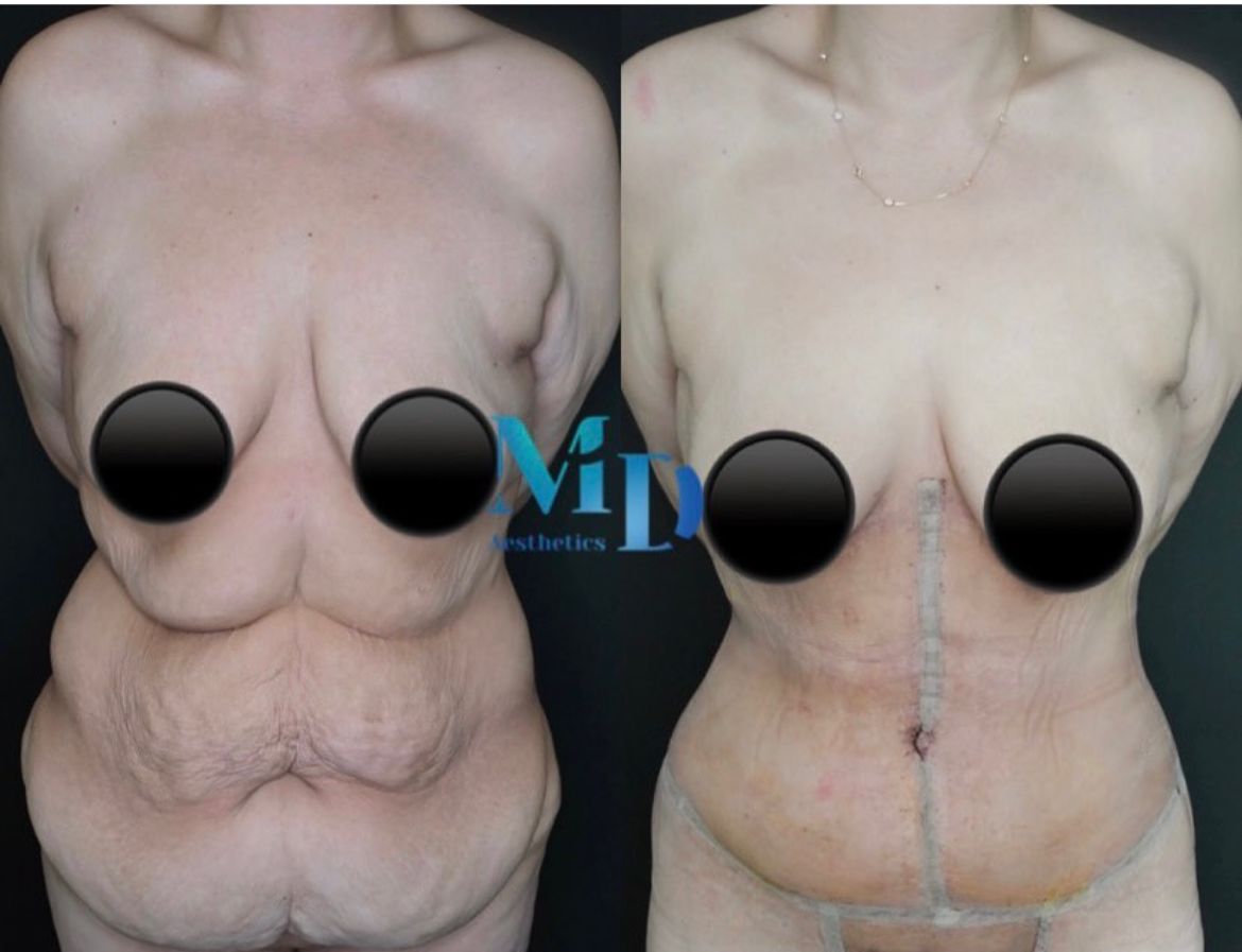 Murat Diyarbakırlıoğlu | Post Bariatric Surgery