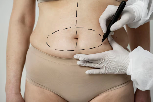 Murat Diyarbakırlıoğlu | Liposucción Vaser – Eliminación de Grasa