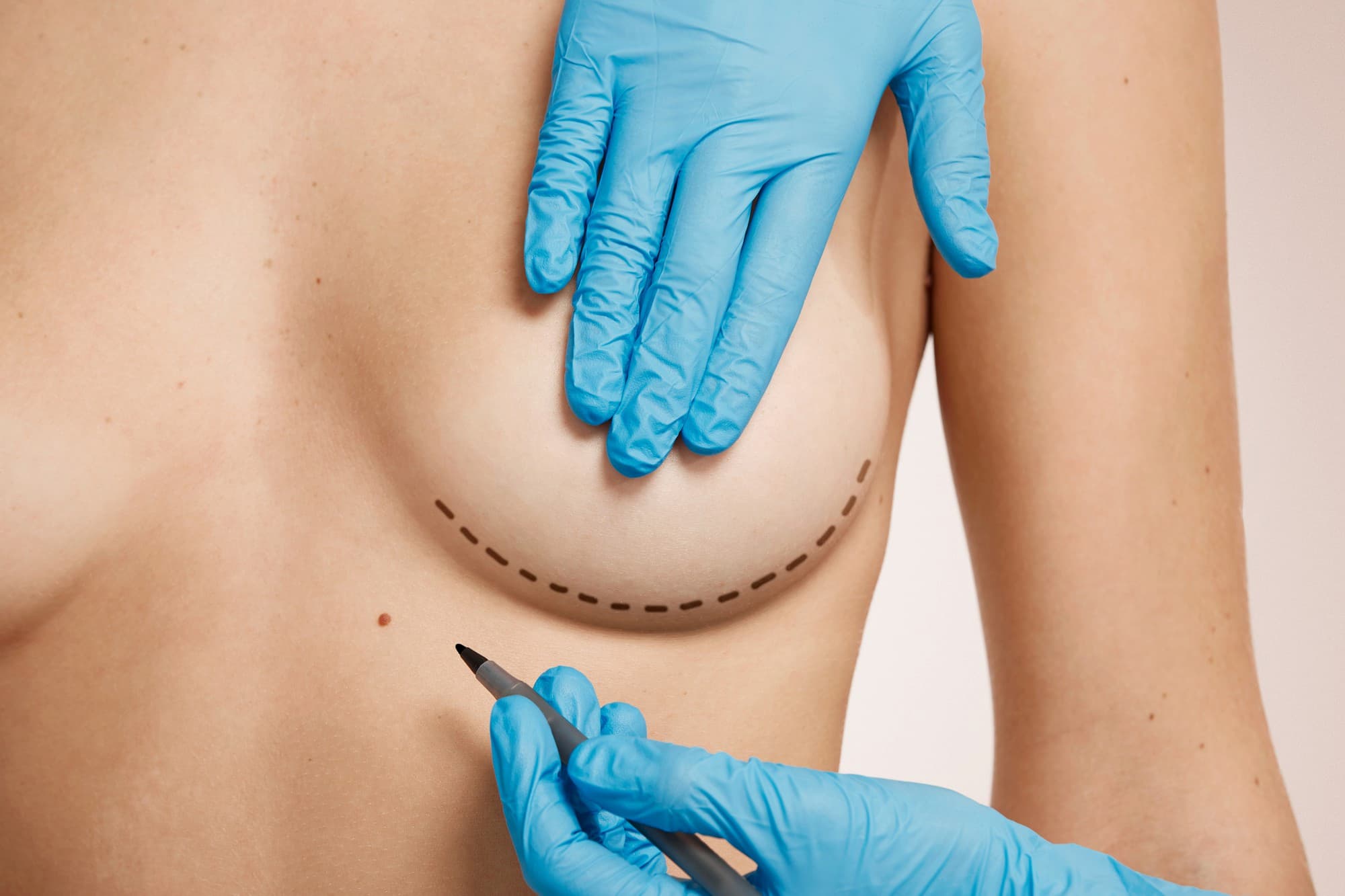Murat Diyarbakırlıoğlu | Breast Lift