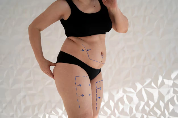 Liposuction, diyet ve egzersize rağmen belirli bölgelerde kalmaya devam eden yağ dokusunu azaltarak vücut konturunu yeniden şekillendirmeyi amaçlayan cerrahi bir işlemdir. Uygulama planı, yağ miktarı kadar cilt elastikiyeti ve kişinin genel vücut oranları değerlendirilerek oluşturulur.