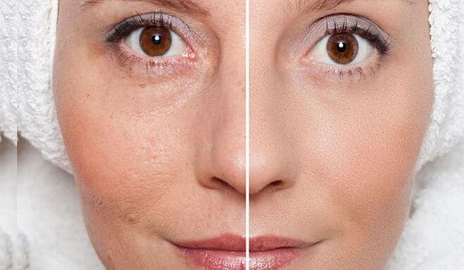 Dermal fillers are non-surgical aesthetic treatments used to restore facial volume, soften selected lines, and enhance facial contours. Hyaluronic acid fillers may be applied to areas such as the lips, cheeks, chin, jawline, and nasolabial folds according to individual anatomy and treatment goals.